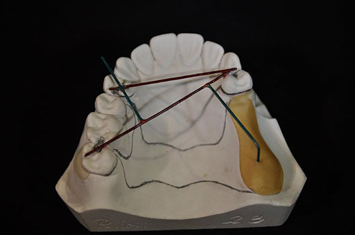 statische Planung - künstliche Zähne sollen mit Klammern am Restzahnbestand fixiert werden (herausnehmbar)