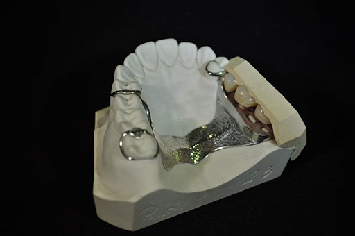 Vorwall zum fixieren der Zähne beim Fertigstellen