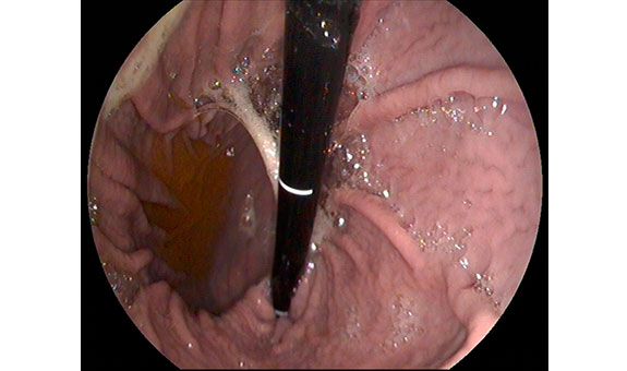 Mit der Ösophago-Gastro-Duodenoskopie können wir Erkrankungen des Verdauungstraktes sicherer diagnostizieren und Fremdkörper ohne Operation entfernen