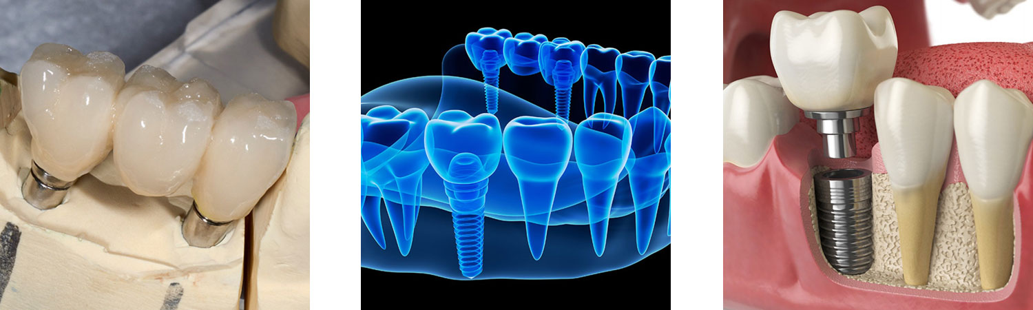 Röder-Dental-Keramik GmbH in Sande - Implantatgestützte Versorgung Röder-Dental-Keramik GmbH in Sande - Implantatgestützte Versorgung