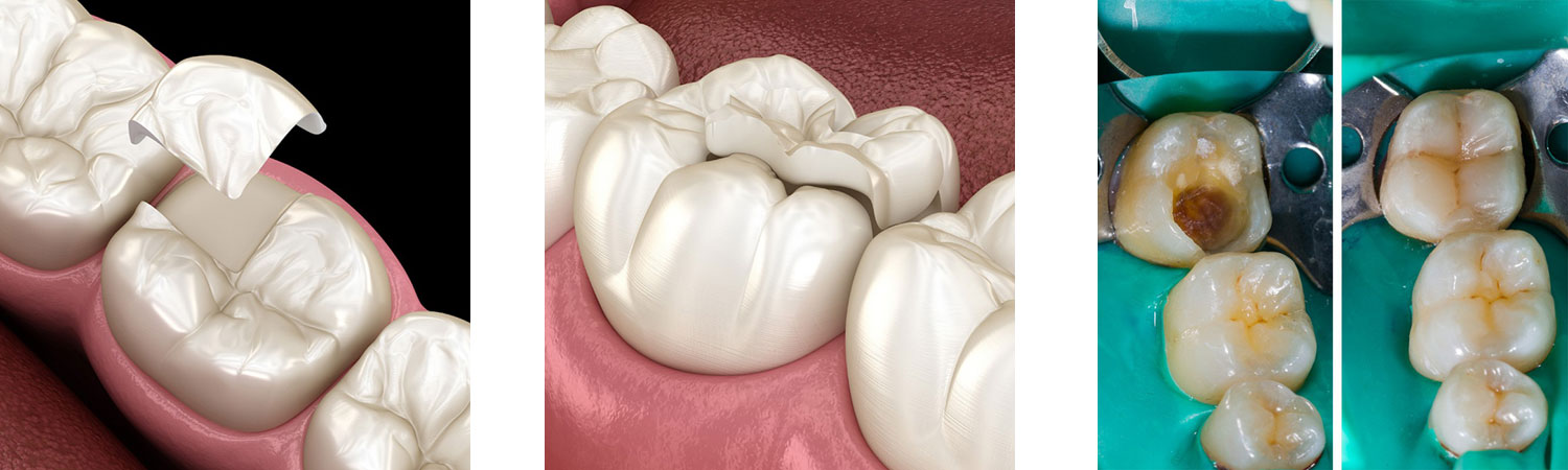 Röder-Dental-Keramik GmbH in Sande - Inlays, Onlays, Teilkronen Röder-Dental-Keramik GmbH in Sande - Inlays, Onlays, Teilkronen