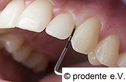 Eine Zahnfleischbehandlung geschieht bei uns unter größtmöglicher Schonung des Zahnfleisches mit minimal invasier Ultraschalltechnik. In Verbindung mit hochwirksamen Spüllösungen (Chlorhexidin) zerstören wir den Biofilm in der Zahnfleischtasche und sorgen für eine Ausheilung der Parodontitis