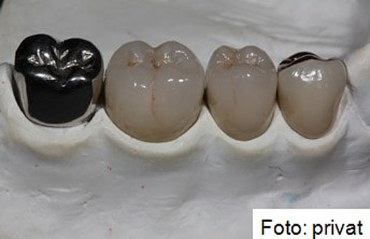 Unser Labor verfügt zur Herstellung von Kronen, Brücken, Inlays, Implantatgetragenem und kombiniertem Zahnersatz über viel Know-How, hochqualifizierte Mitarbeiter und eine Vielfalt fortschrittlicher Technologien und Materialien