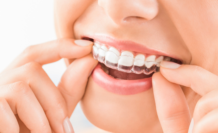 Zahnschienen gegen Zahnfehlstellungen